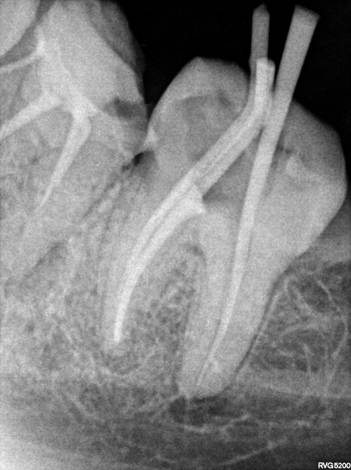 Dental X-ray